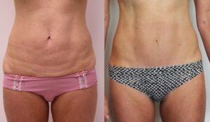Mini Abdominoplasty results 3, before and afters , Dr Rastogi