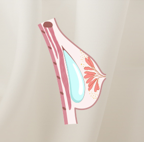 placement of breast implants img Placement of Breast Implants - 4